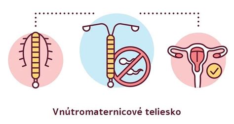 Schéma vnútromaternicového telieska Mirena