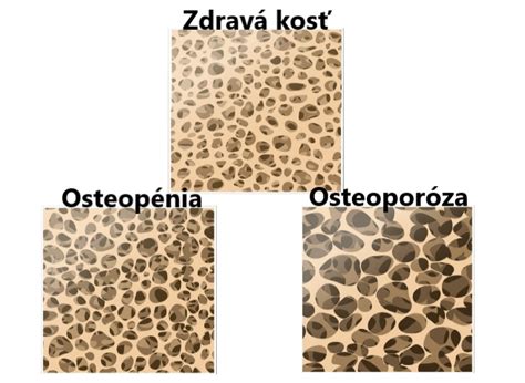 Schéma štruktúry zdravej a osteoporotickej kosti