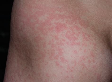 Motýlikovitá vyrážka na lícach dieťaťa pri piatej chorobe
