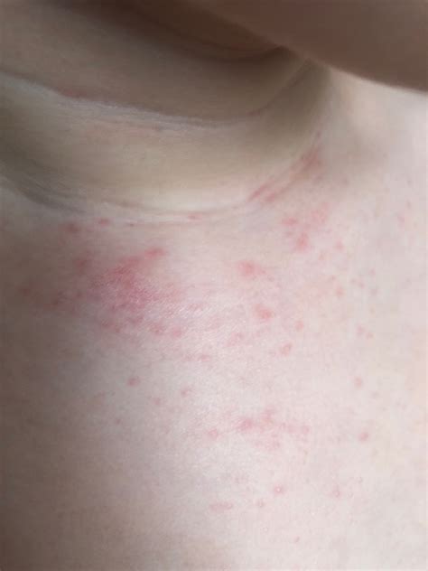 Infografika porovnávajúca suchú pokožku a atopický ekzém