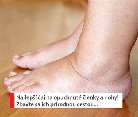 Ilustrácia zadržiavania vody v tele