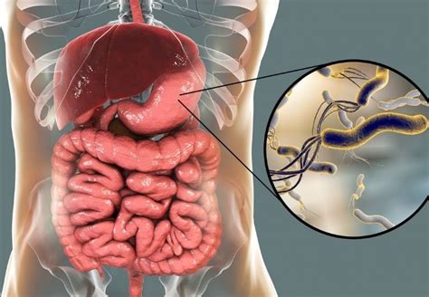 Ilustrácia vírusovej infekcie tráviaceho traktu