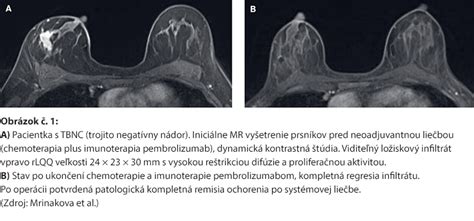 Anatómia prsníka a proces tvorby mlieka