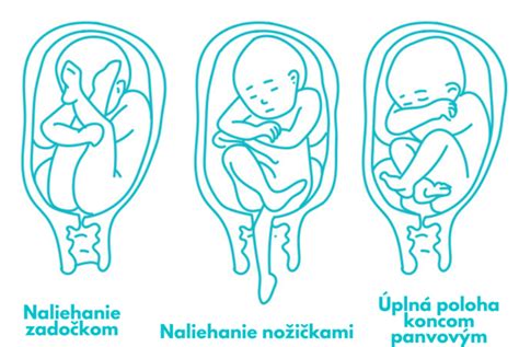 Ilustrácia pozdĺžnej polohy koncom panvovým