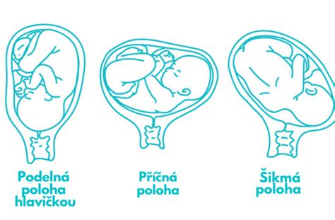 Schematické znázornenie priečnej polohy plodu