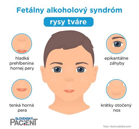 fetálny alkoholový syndróm - charakteristické črty tváre