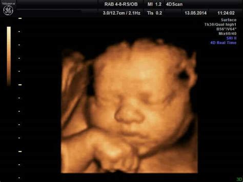 technológia 4D ultrazvuku