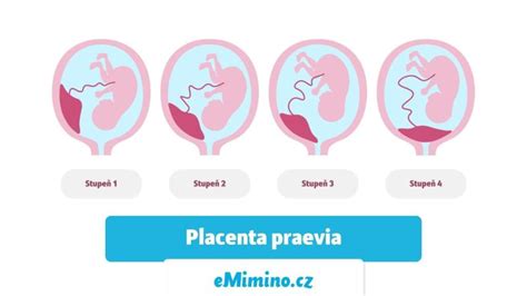schematické znázornenie polôh placenty praevia